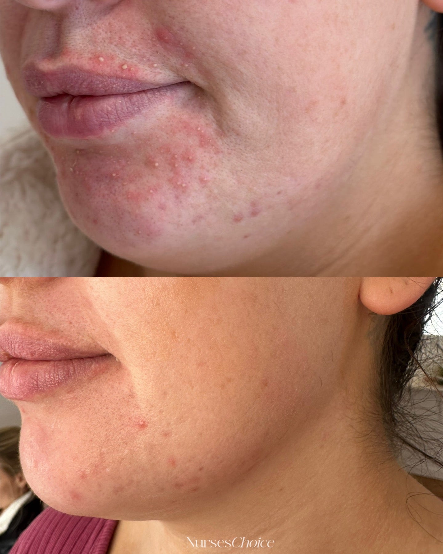 Week 4 - Finally beautifully soft, youthful skin